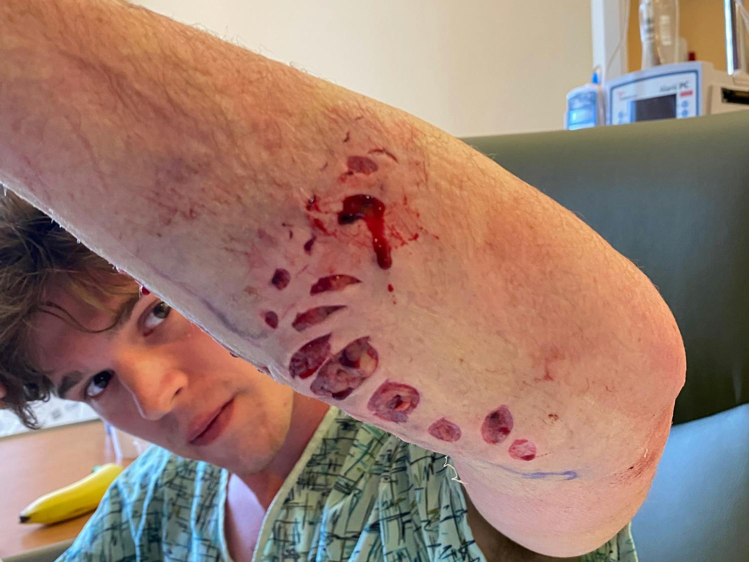 Bryce Albert shark attack