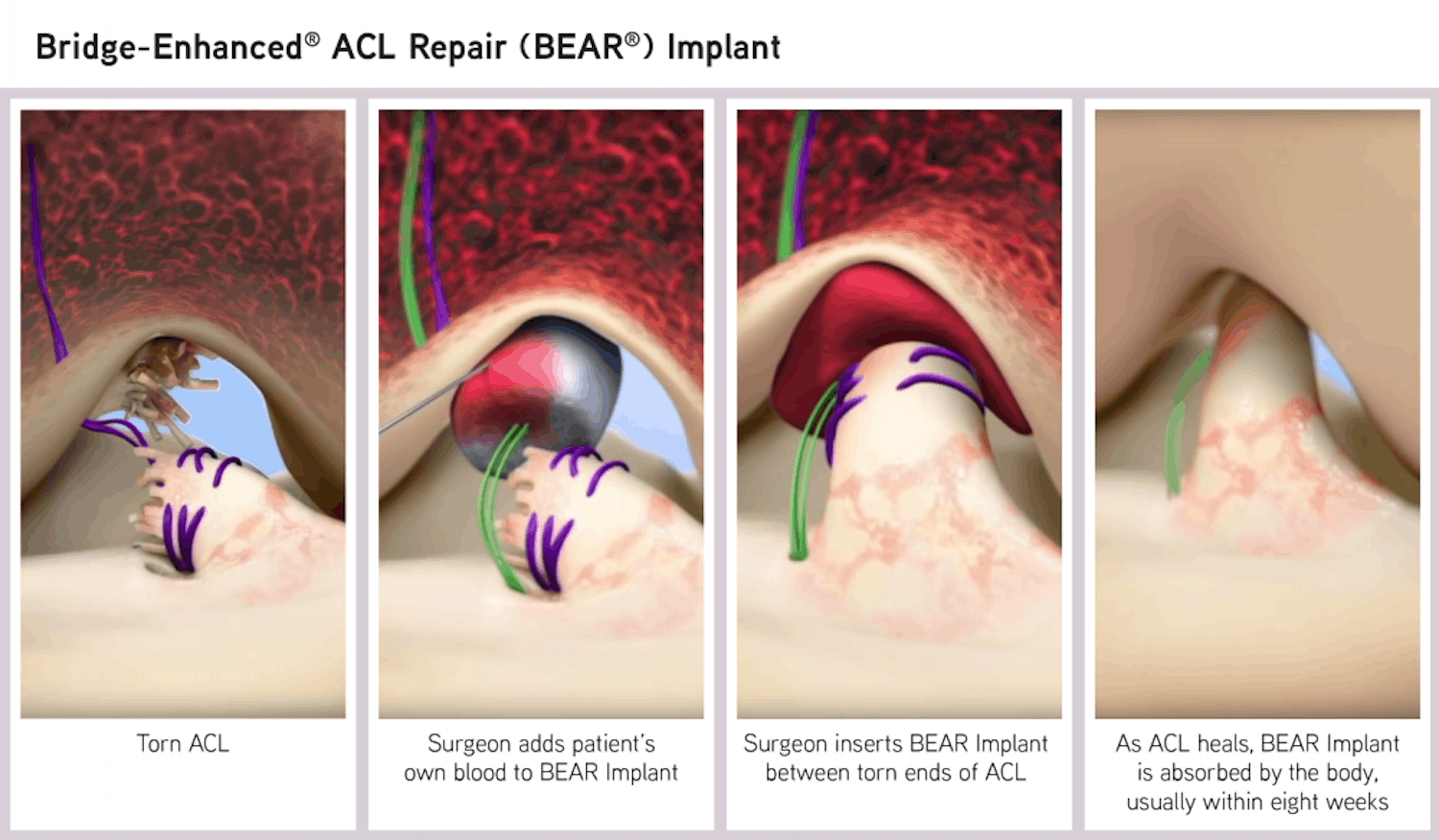 BEAR_Implant_Process