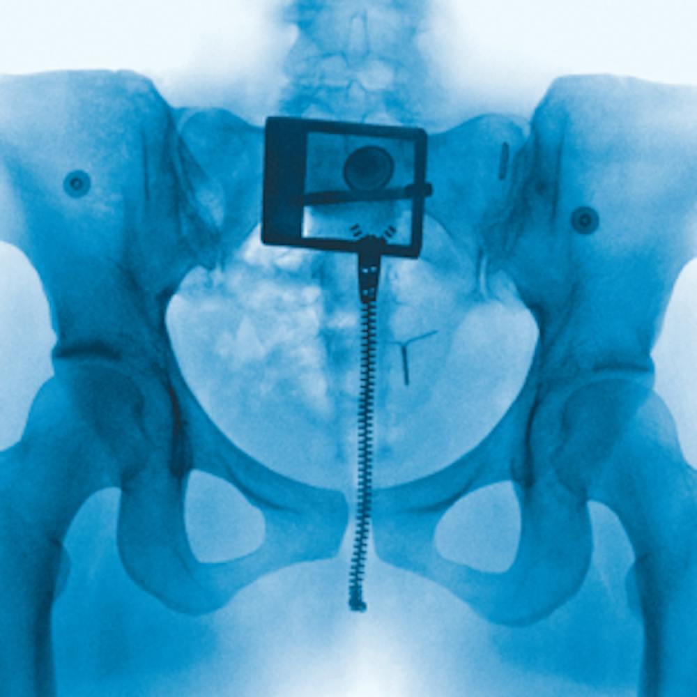 A blue x-ray of Lorde's pelvis with a zipper, belt buckle and an intrauterine device visible.
