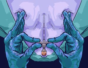 An illustration of gloved hands carefully inserting a needle into someone’s back.
