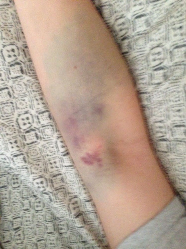 Senior creative writing major Rachael Heffner shows the bruises on her arm after donating plasma Jan. 7. Two weeks ago, she developed hematoma after donating at BioLife, where an employee had accidentally nicked her vein. Hematoma occurs when there is a collection of blood outside of a blood vessel and causes the skin to swell as well as causes bruises. PHOTO PROVIDED BY RACHAEL HEFFNER