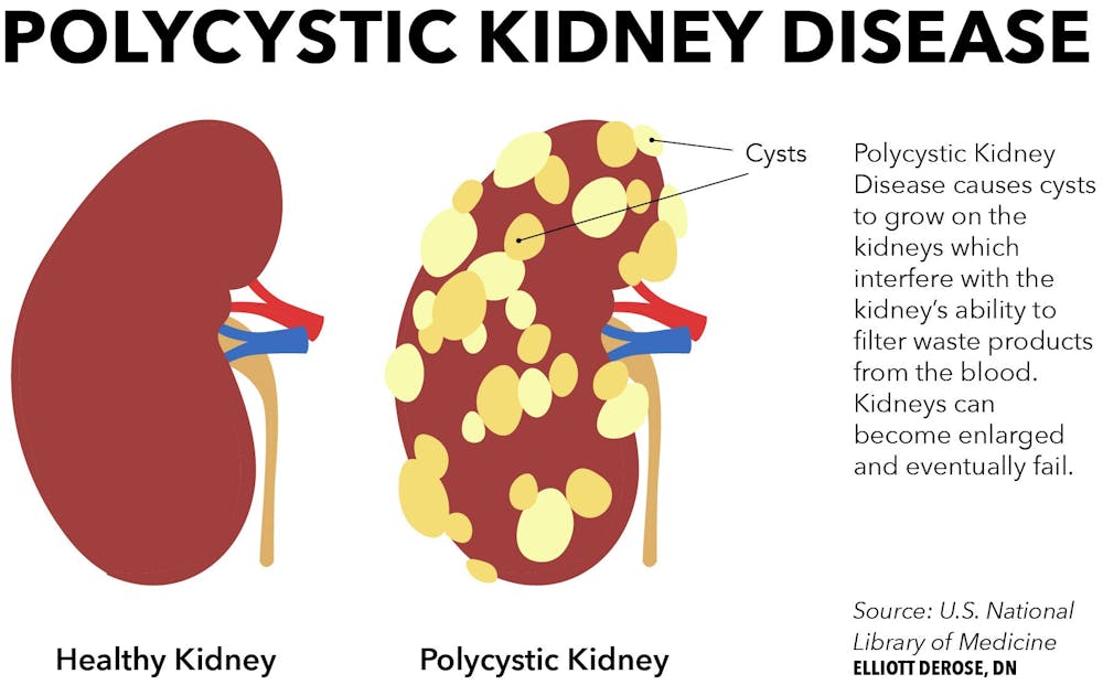 Polycystic kidney disease.jpg