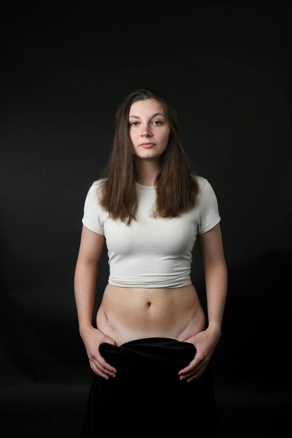 <p>Meghan Sawitzke shows scars on her hips while posing for a photo Oct. 9, 2024 at Ball State University in Muncie, Indiana. Mya Cataline, DN</p>