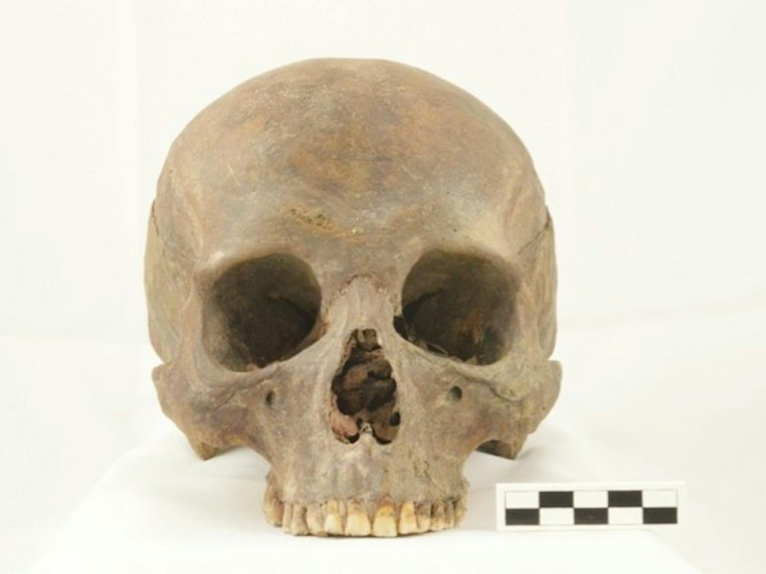 A skull (pictured) recovered from the excavations done on on the former Erie County Poorhouse cemetery, which was located on South Campus before UB purchased the land.