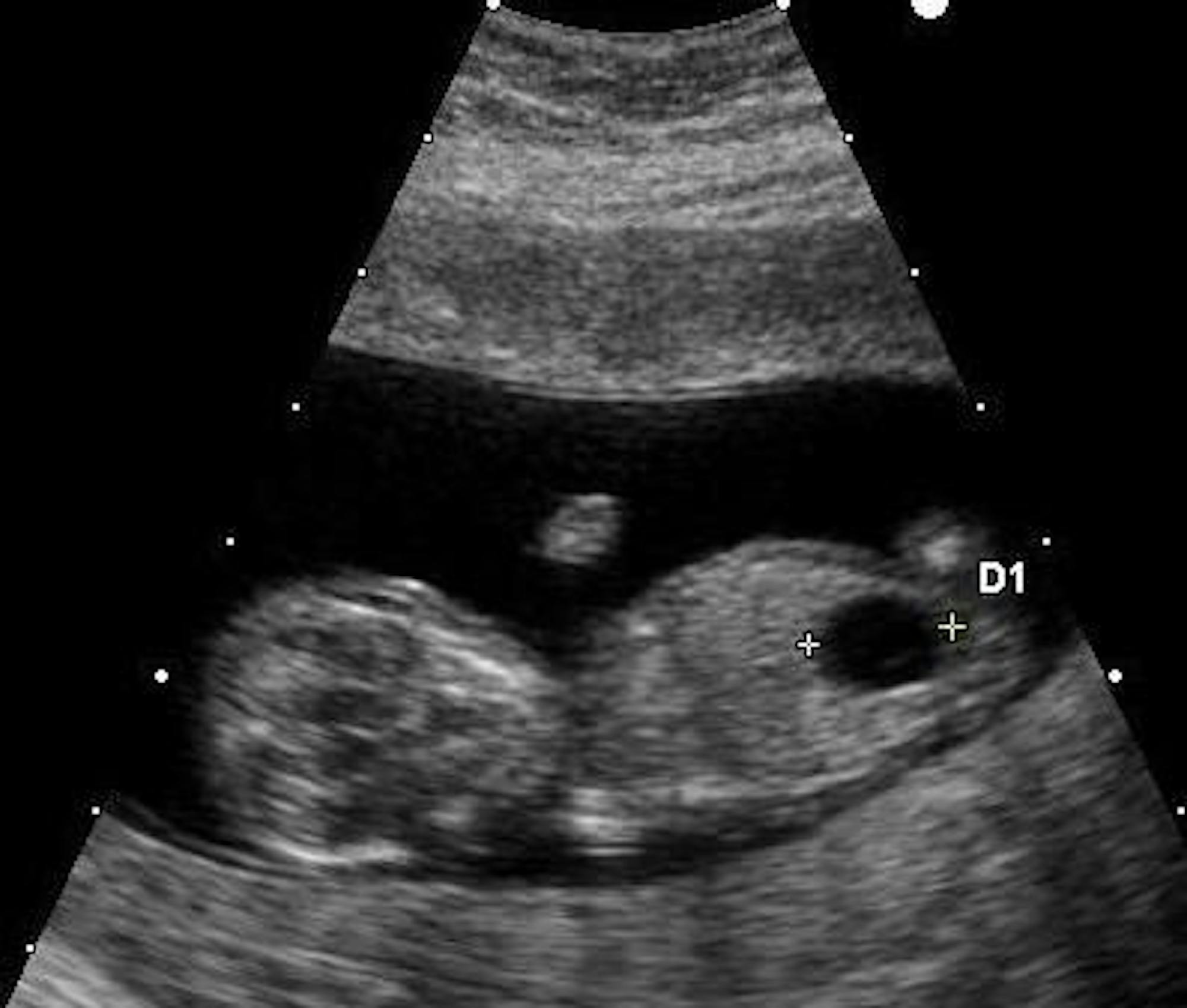 Ultrasound