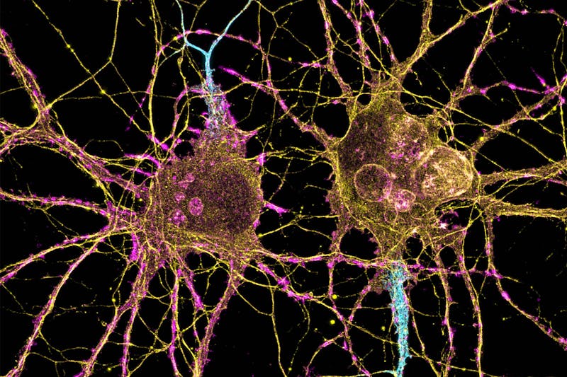 UW researchers identify revolutionary biomarkers for early detection of Huntington’s disease