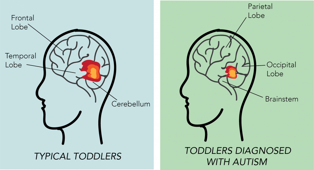 Both boys and girls diagnosed with autism show underdeveloped neural activity in certain areas of the brain.&nbsp;