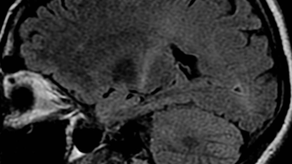 Radicava could help mitigate the effects of ALS, a neurodegenerative disease that attacks nerve cells controlling muscles.