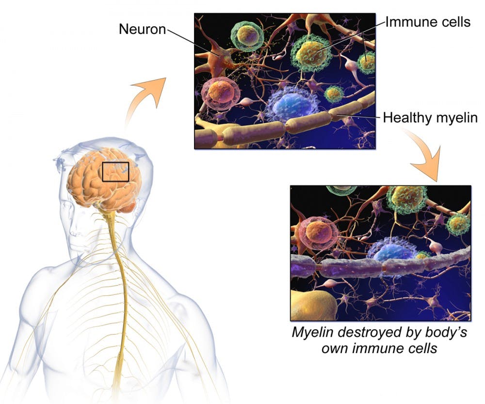 Ocrevus has become the first drug to receive FDA approval for the treatment of&nbsp;primary progressive Multiple Sclerosis, an inflammatory disease of the central nervous system.