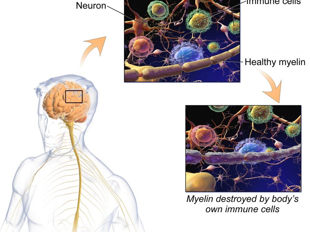 Ocrevus has become the first drug to receive FDA approval for the treatment of&nbsp;primary progressive Multiple Sclerosis, an inflammatory disease of the central nervous system.