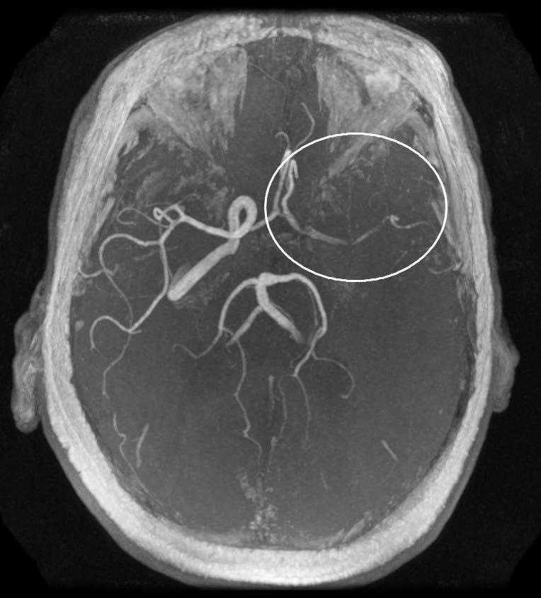 Ischemic stroke occurs when an artery that normally brings fresh blood to brain is blocked, causes neurons in the brain to starve.&nbsp;