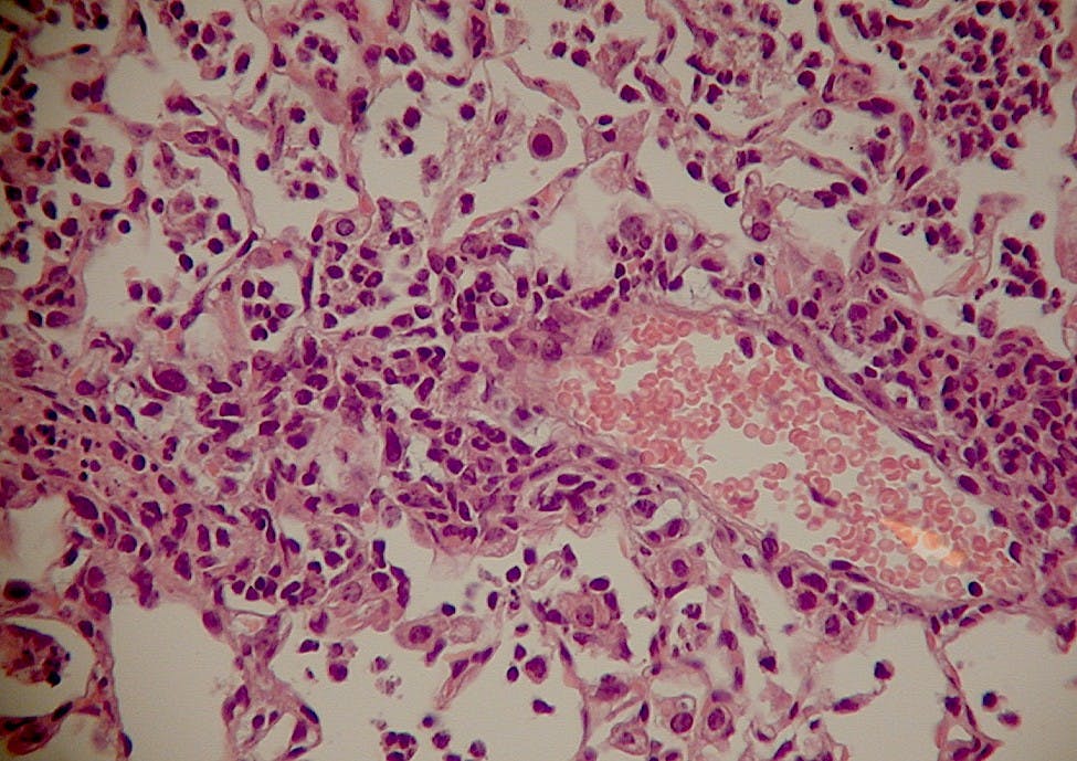 Hepcidin's ability to promote iron sequestration by cells could help treat bacterial infections like pneumonia.