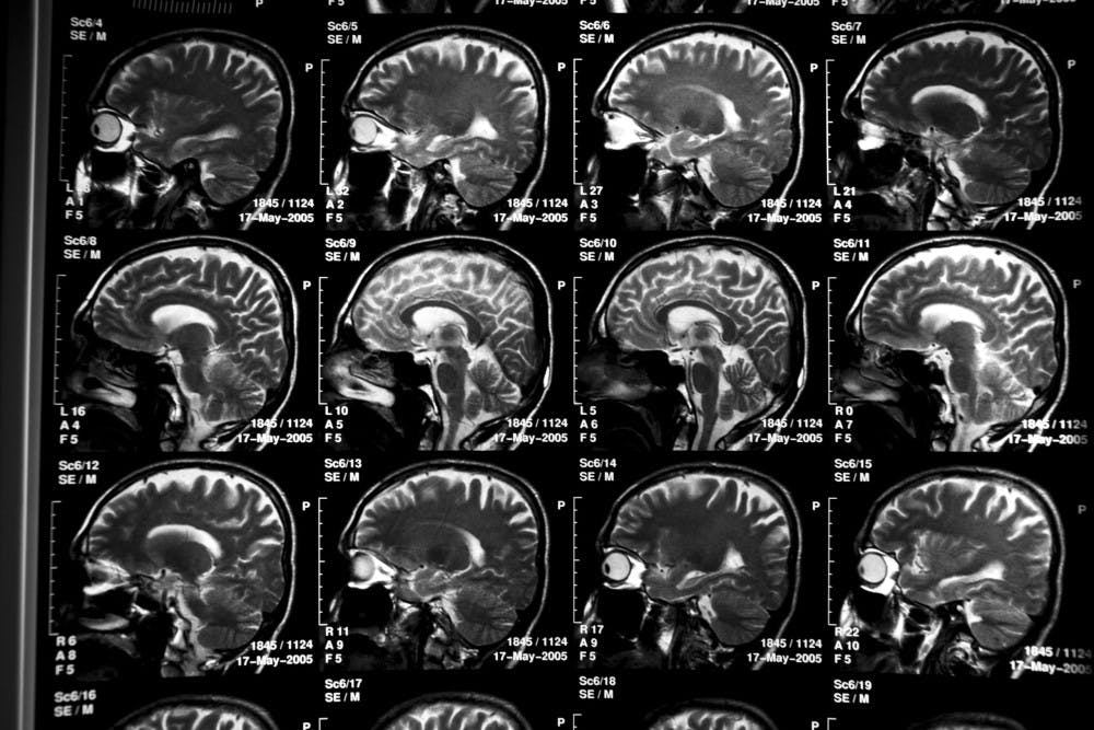 ALZHEIMERS_TRIAL_PREVENTION_7-scaled