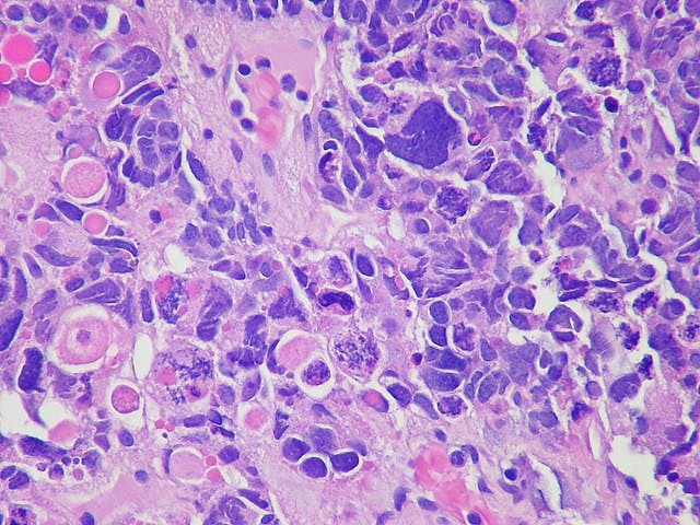 cancercells