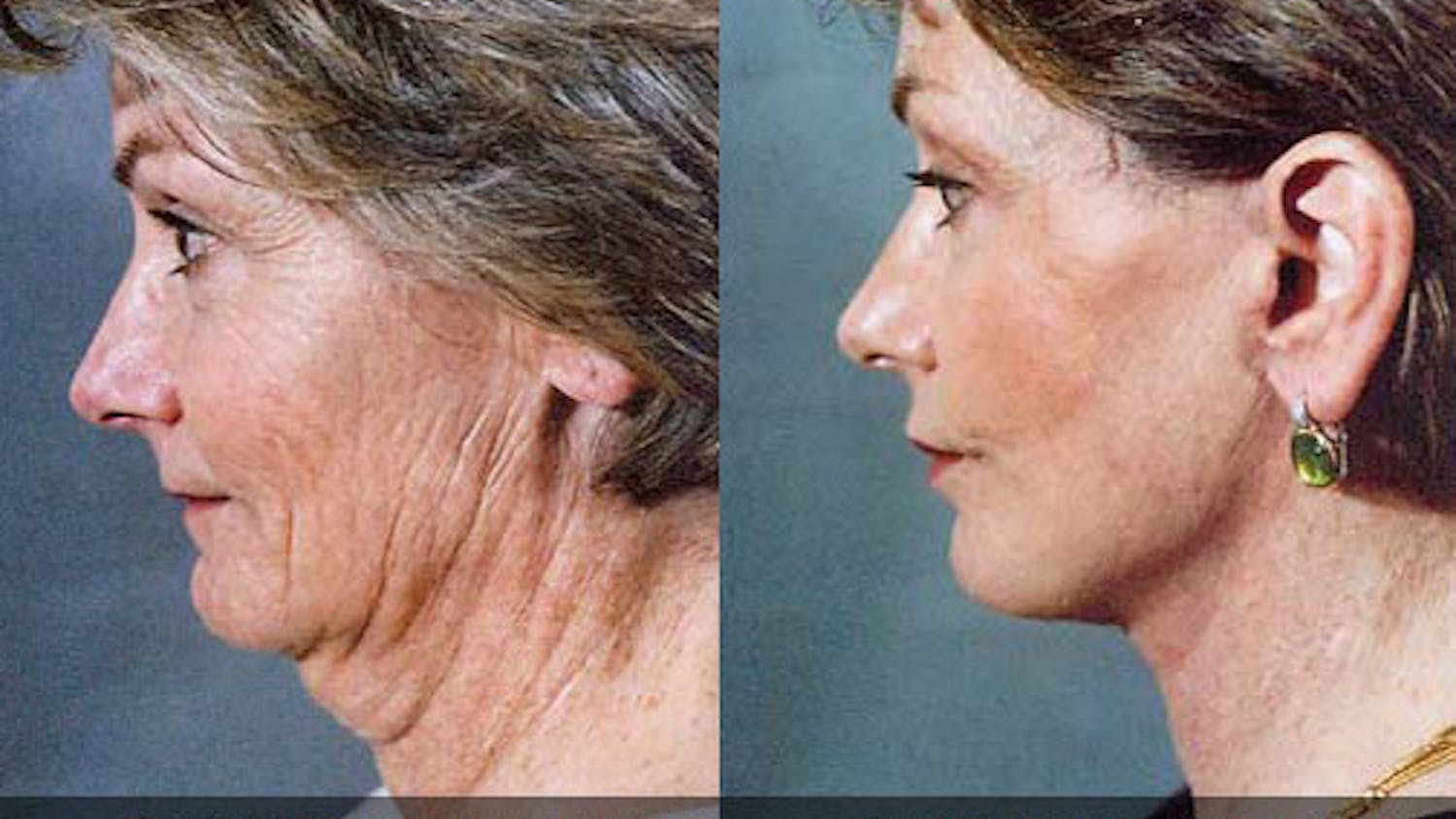 Face_Lift_02_Dr._Ristow.jpg