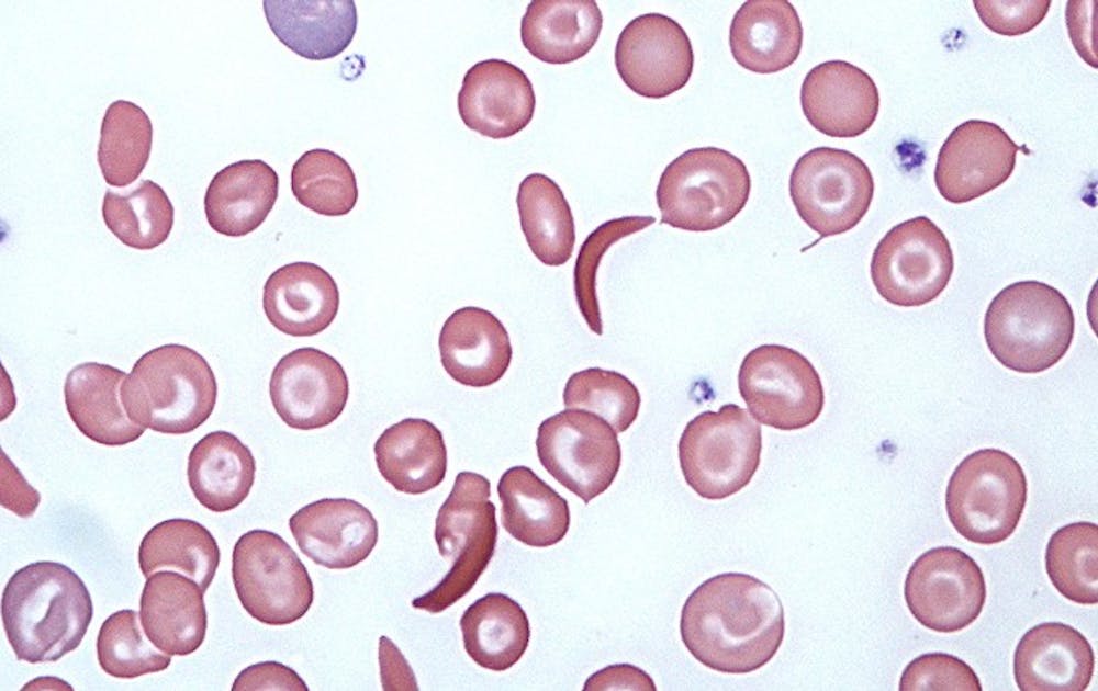 New Duke research shows that sickle cells, the crescent-shaped cells above, may play a role in treating cancer tumors—despite their association with the disease sickle cell anemia.