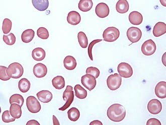 New Duke research shows that sickle cells, the crescent-shaped cells above, may play a role in treating cancer tumors—despite their association with the disease sickle cell anemia.