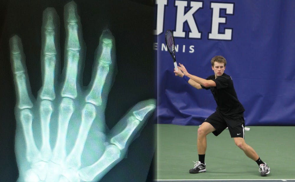 After a run-in with a fence during a tennis match in San Diego, redshirt junior Cale Hammond did not need an X-ray to see he lost the top joint of his left index finger.