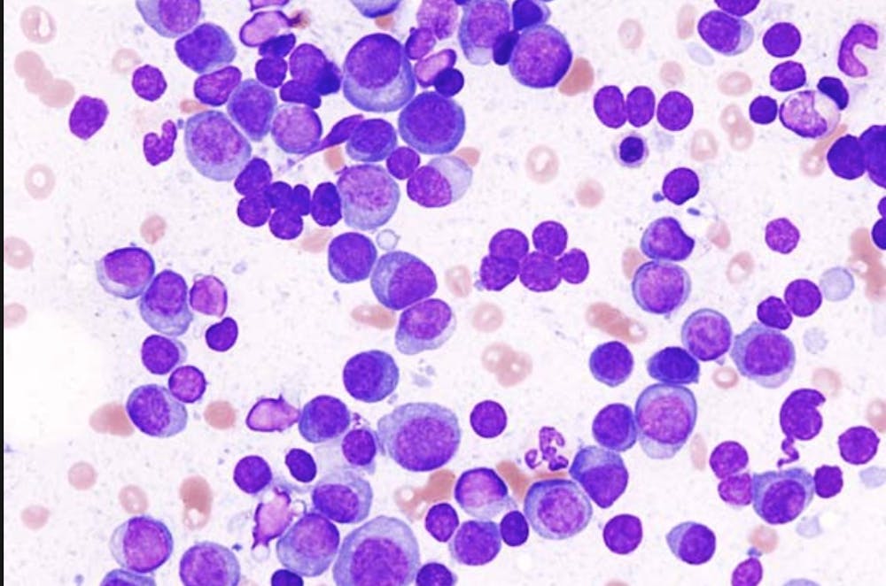 Multiple myeloma cancer cells | Courtesy of Wikimedia Commons