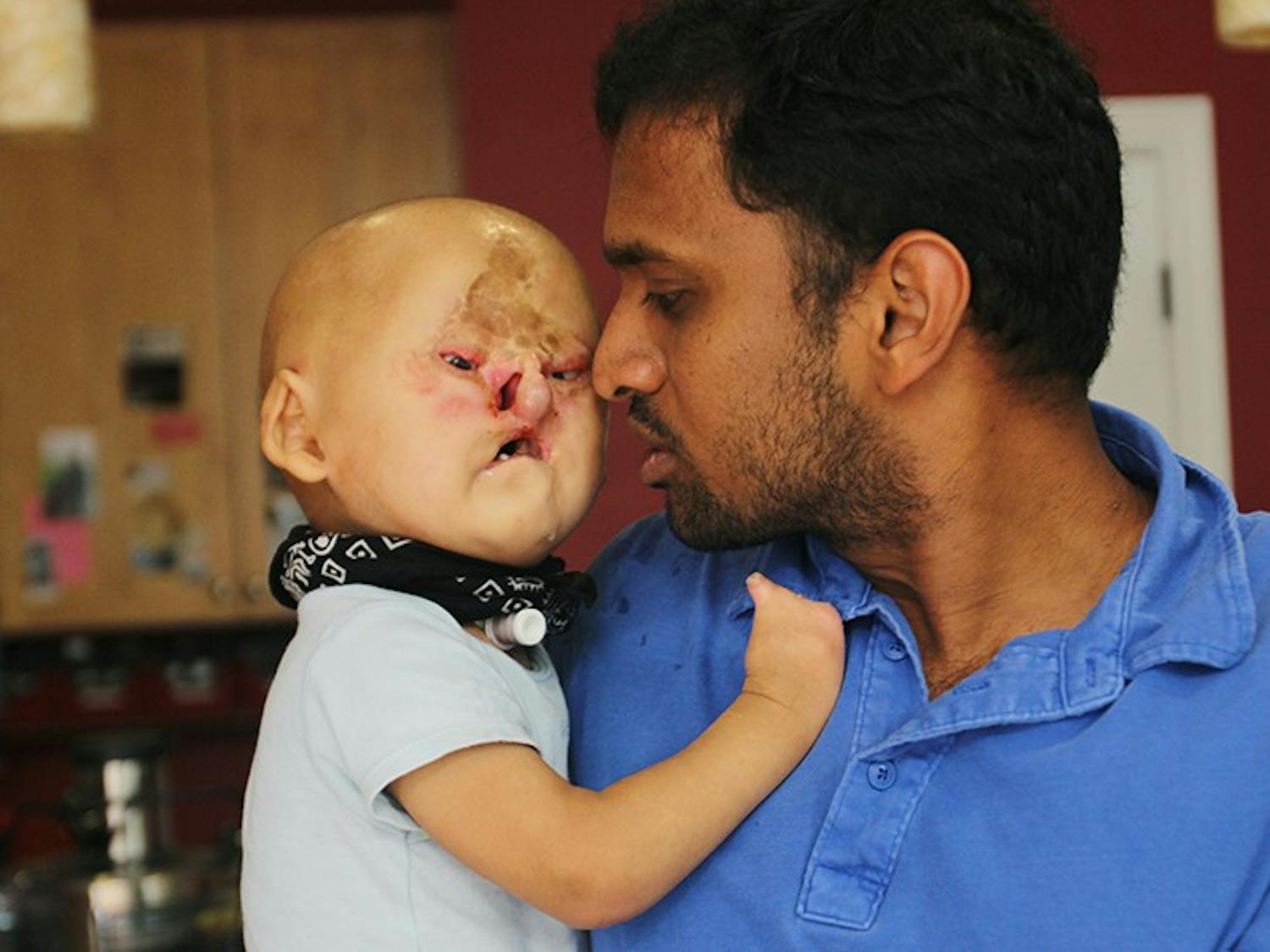 Adam Phaulraj was born with Bartsocas-Papas syndrome, of which there are only 24 known cases. He is currently undergoing a series of surgeries at UNC Hospitals.