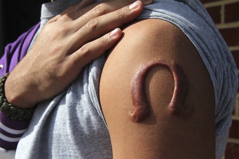 Jeffrey Beckett’s brand formed a keloid scar on his shoulder, which he said took several months to fully heal.