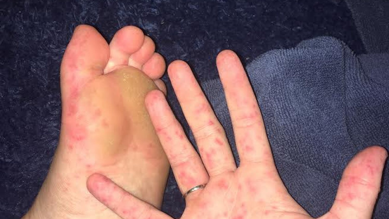 Hand, foot and mouth disease has spread on campus.
