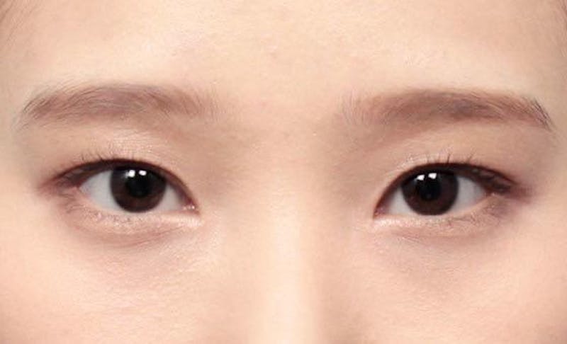 1 in 5 Korean women have undergone plastic surgery, compared to just 1 in 20 in the United States.
