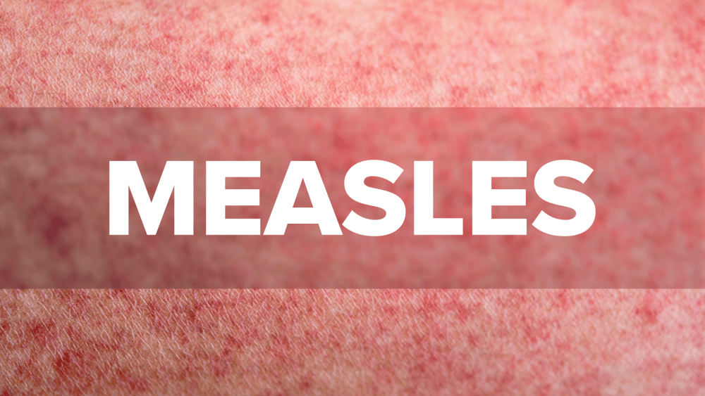 measles-01