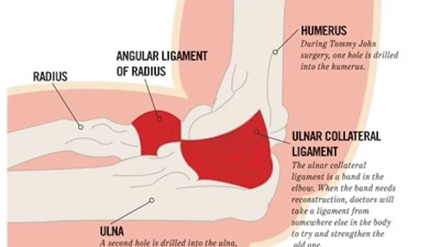 Tommy John surgery, a procedure that consists of taking a ligament from somewhere else in the body and putting it into the elbow, is becoming more common in young pitchers.