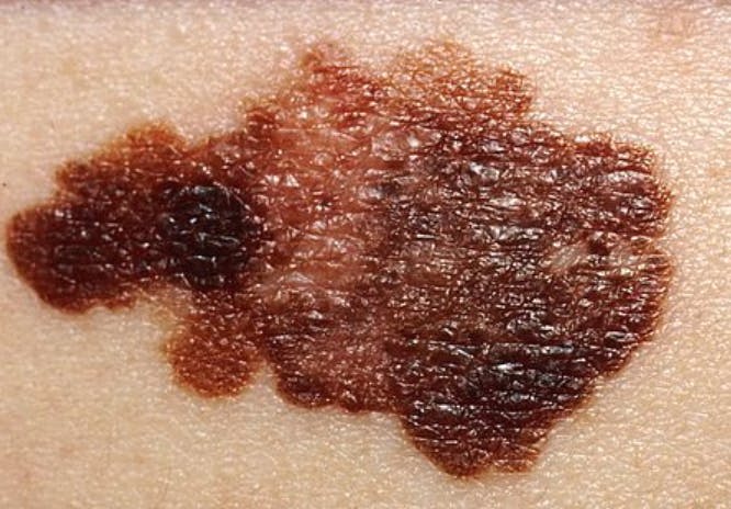 PUBLIC DOMAIN
Melanoma affects the melanocytes of the skin, which work in pigmentation.&nbsp;