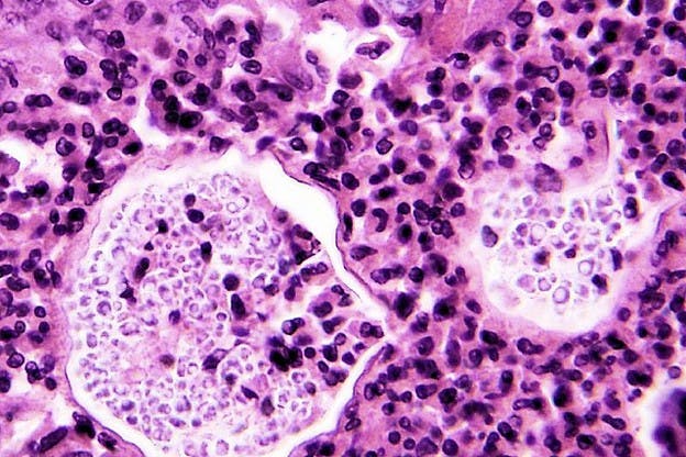 COURTESY OF ML COHEN VIA FLICKR
Over 200 cases of meningitis have now been reported across 15 states.