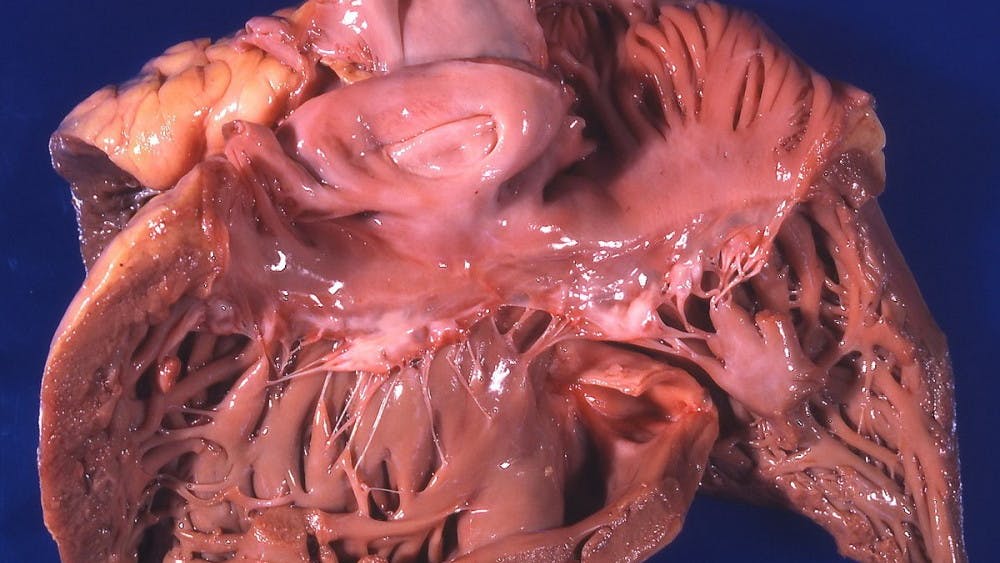 rosen/cc-By-2.0
A serious bacterial infection rendered Benoit unable to receive a lung transplant.