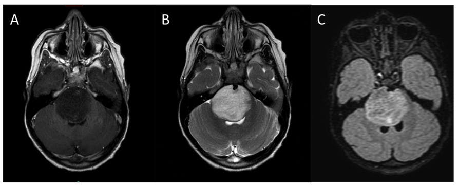 KATHERINE E. WARREN&nbsp;/ CC BY 3.0
MRI images of a brain affected by diffuse intrinsic pontine glioma, an aggressive pediatric brain cancer and a focus of Craig-Schwartz’s research as an undergraduate at Hopkins.