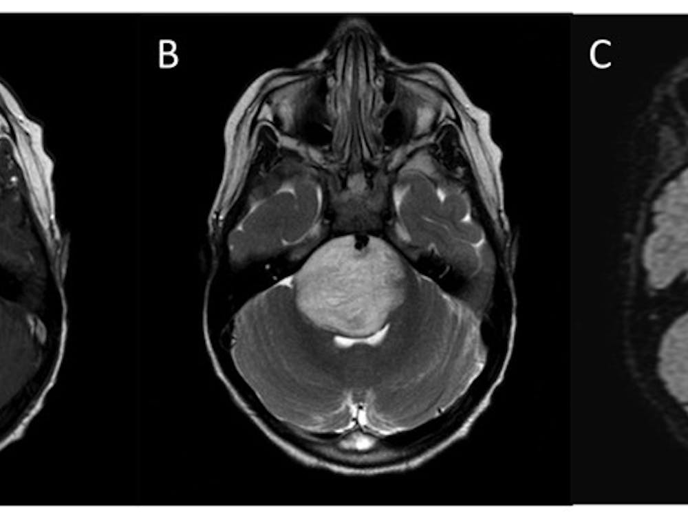 KATHERINE E. WARREN&nbsp;/ CC BY 3.0
MRI images of a brain affected by diffuse intrinsic pontine glioma, an aggressive pediatric brain cancer and a focus of Craig-Schwartz’s research as an undergraduate at Hopkins.