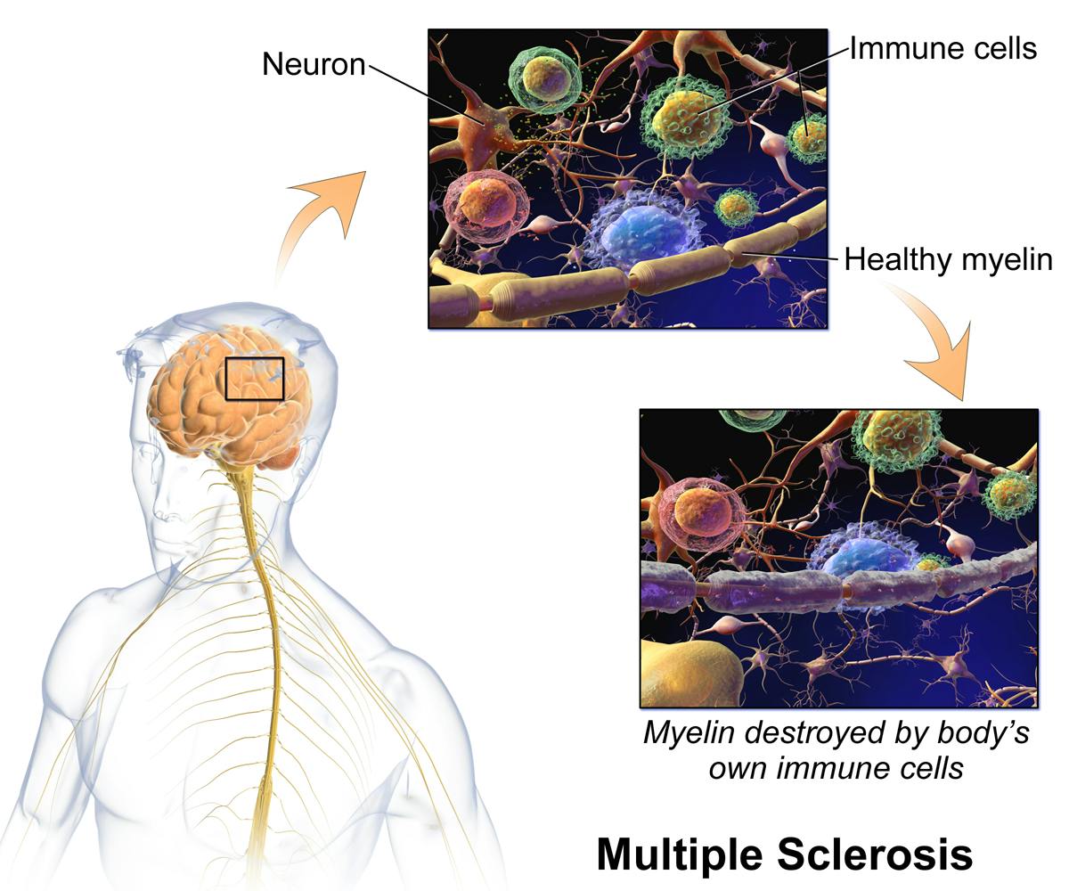 BLAUSEN MEDICAL COMMUNICATIONS, INC / CC BY-SA 4.0
Multiple sclerosis (MS) is an autoimmune disease that destroys the protective layer of nerve cells.
