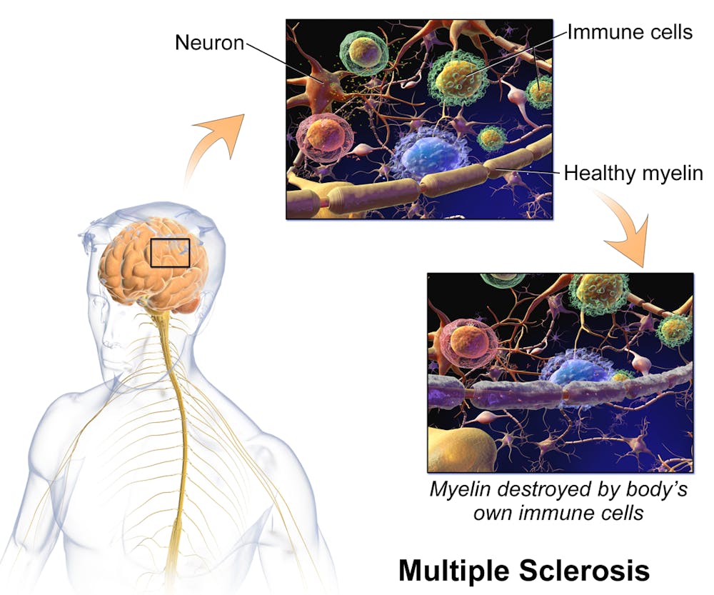 multiple-sclerosis