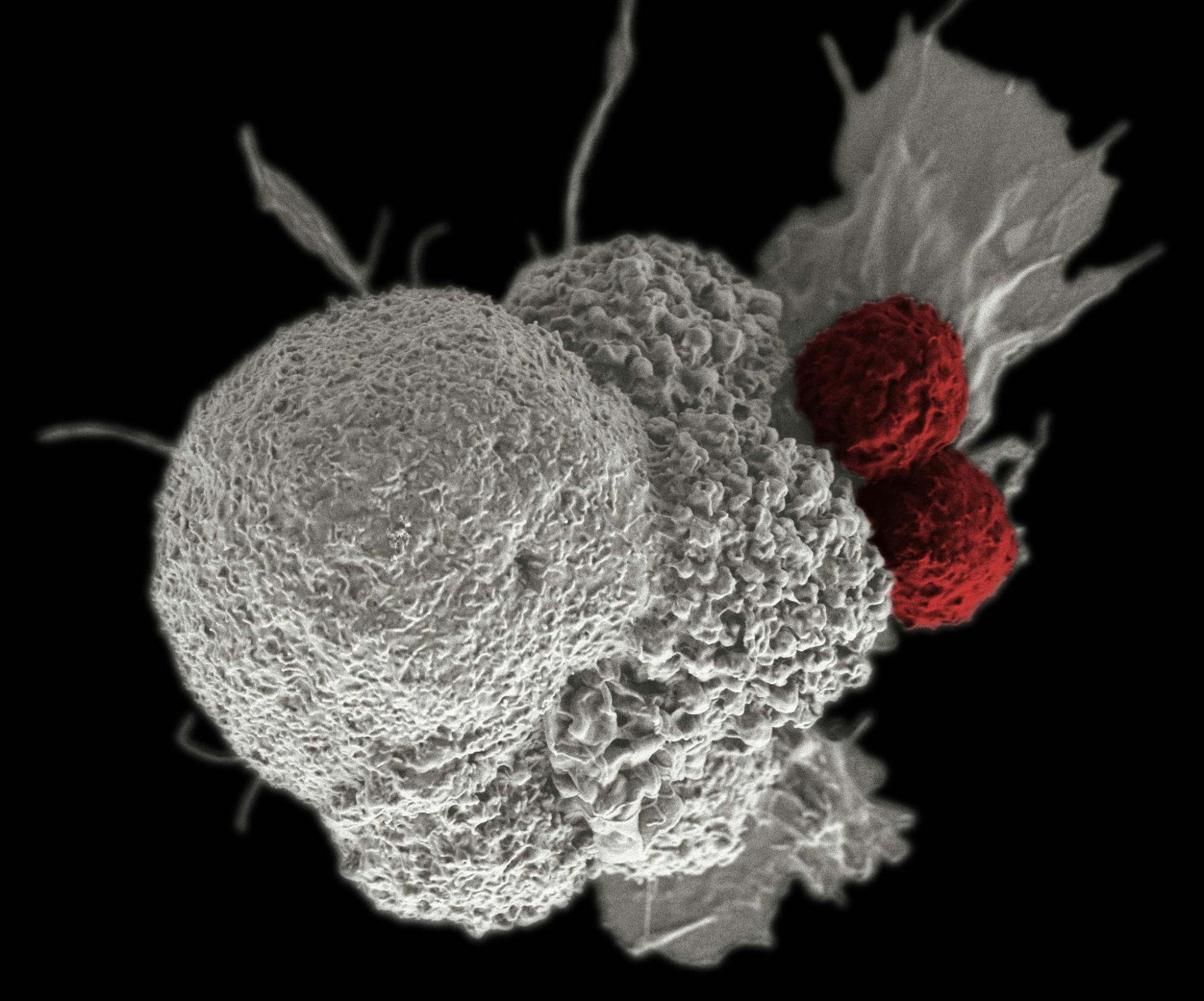 RITA ELENA SERDA / CC BY-NC 2.0
A cancer cell (white) is attacked by two immune cells (red). Cancer immunotherapy aims to activate T cells to attack specific tumors.&nbsp;