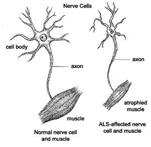 cs.fredonia.edu
ALS manifests itself as weakening muscles from neuronal degeneration.  