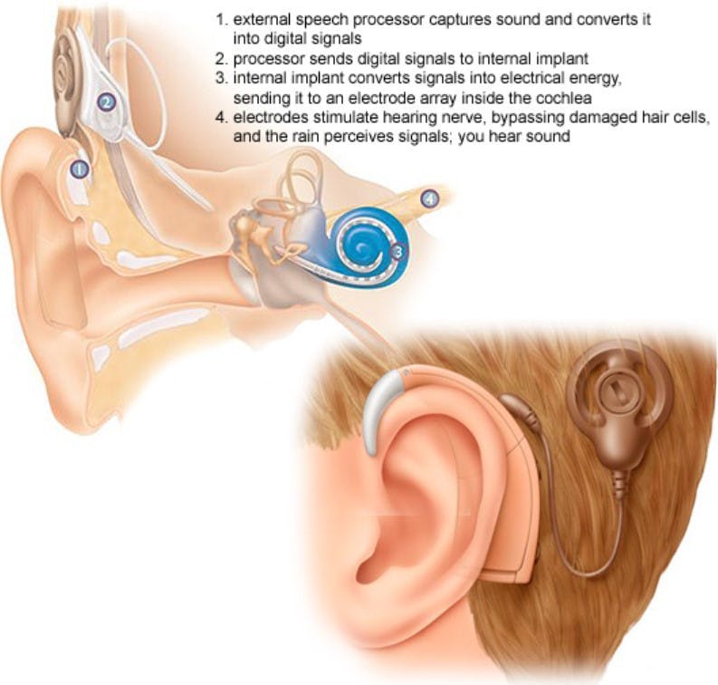 CC BY 4.0 / BC FAMILY HEARING
Cochlear implants have opened doors for many people with hearing loss, like Dr. Chad Ruffin.&nbsp;