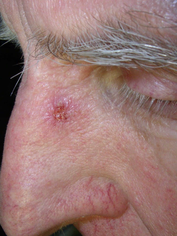 Public Domain
Chemicals produced by bacteria can protect people from skin cancer.