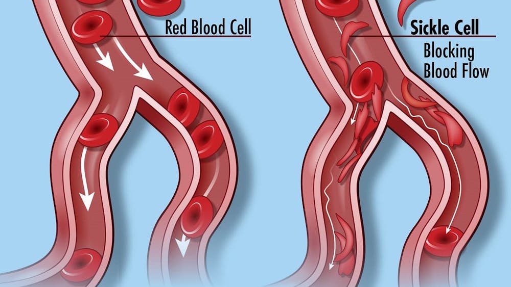 NATIONAL INSTITUTES OF HEALTH / CC BY-NC 2.0
Sickle cell disease, an inherited disorder that interferes with red blood cells, may be linked to increased maternal mortality.&nbsp;