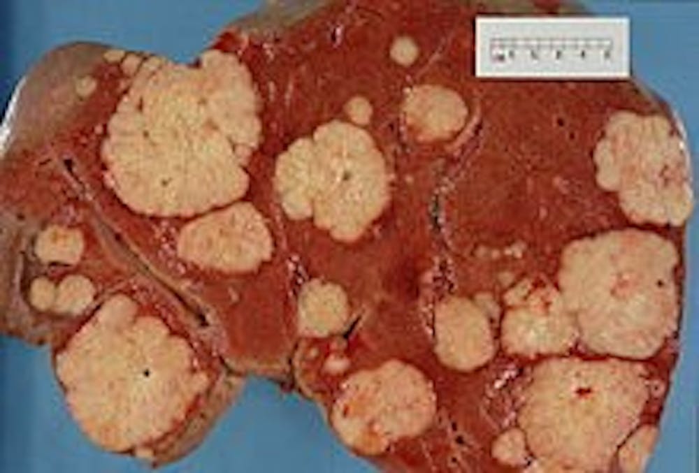 HAYMANJ/CC-BY-2.0
Pancreatic tumors are treatable by surgical removal only at early stages.