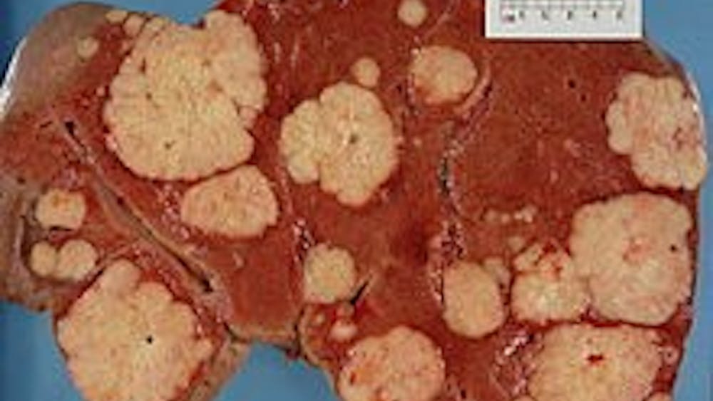 HAYMANJ/CC-BY-2.0
Pancreatic tumors are treatable by surgical removal only at early stages.