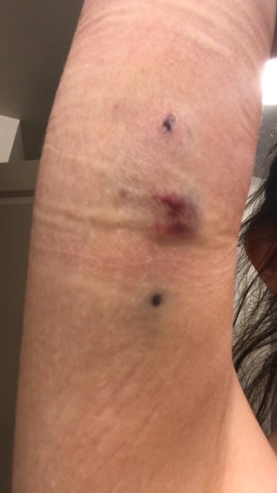 COURTESY OF SARINA REDZINSKI.&nbsp;
Beyond bruising, Nexplanon can take a toll on one’s mental health.&nbsp;