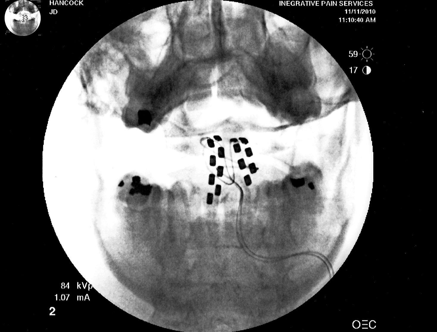 JD HANCOCK / CC BY 2.0 DEED
A recent paper presented a novel spinal stimulator more efficient than traditional methods, like the one shown above.