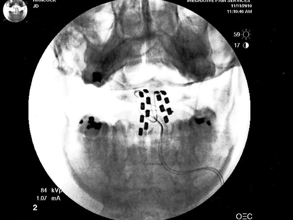 JD HANCOCK / CC BY 2.0 DEED
A recent paper presented a novel spinal stimulator more efficient than traditional methods, like the one shown above.