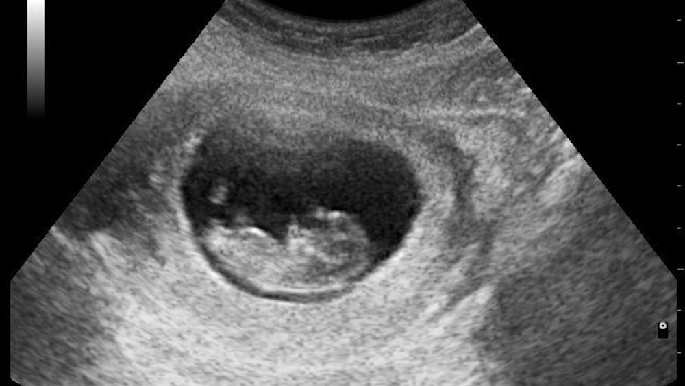 DILMEN/CC-By-3.0
Physical and mental birth defects may be antidepressant-associated.