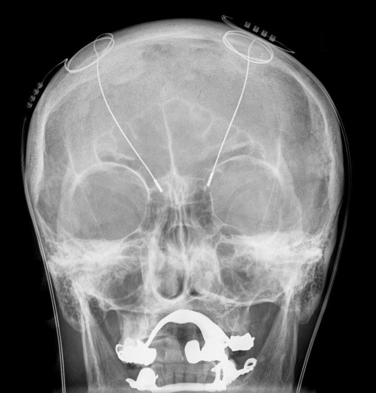 HELLERHOFF/ CC-BY--SA-3.0
This x-ray shows DBS probes attached to the head of a patient.