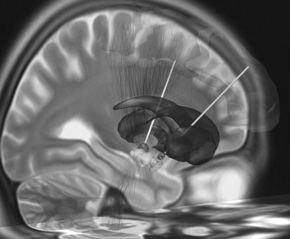 ANDREASHORN/CC-BY-SA-4.0
Deep brain stimulation techniques are used to help patients recover from their comas.