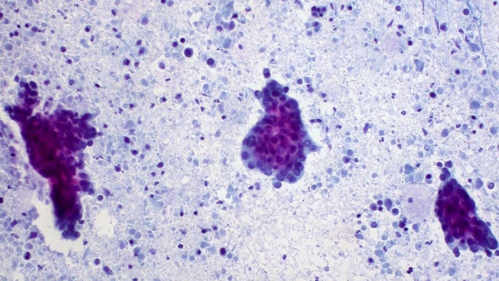 ED uthman/cc-by-2.0
Molecules outside the cell may show pancreatic cancer development.